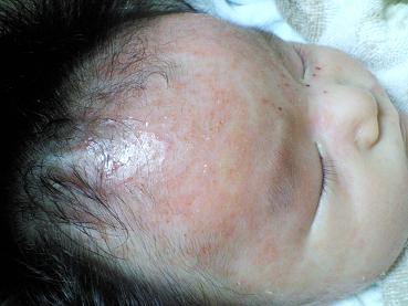 乳児湿疹 脂漏性湿疹 の治療を記録したブログ 治療開始１日めの状態