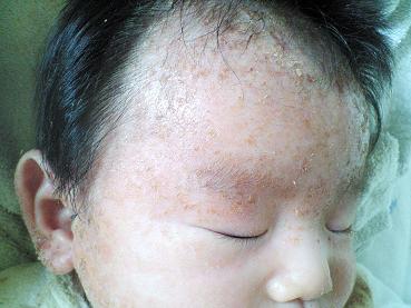 乳児湿疹 脂漏性湿疹 の治療を記録したブログ 治療開始２日めの朝の状態